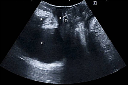 The effect of the distance between mesh and the urethra on sexual function in patients who underwent transobturator tape