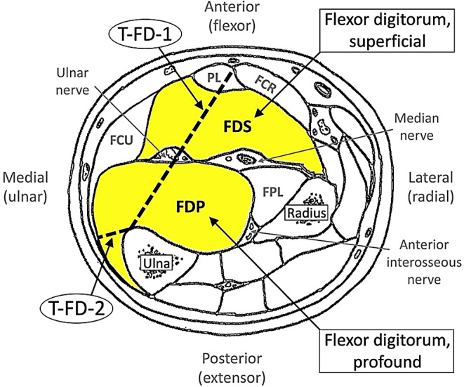 The impact of fine motor activities like playing musical instruments on the thickness and strength of the flexor digitorum muscle.