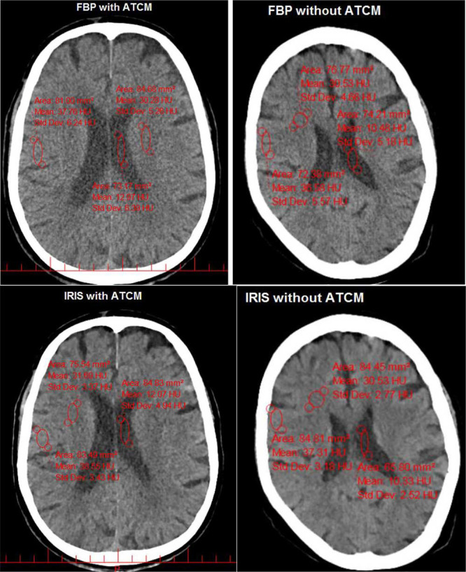 Performance of Iterative Reconstruction in Image Space Algorithm in Combination with Automatic Tube Current Modulation Compared to Filtered Back Projection in Brain CT Scan.