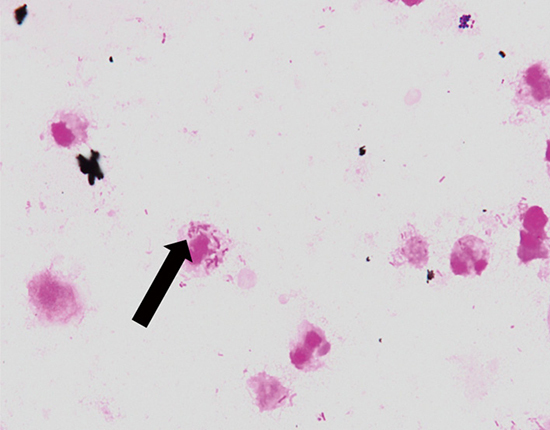 Decubitus ulcer infection and bacteremia due to tazobactam/piperacillin-resistant <i>Veillonella parvula</i>.