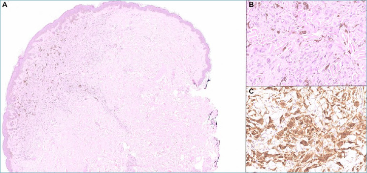 The 2023 WHO updates on skin tumors: advances since the 2018 edition.
