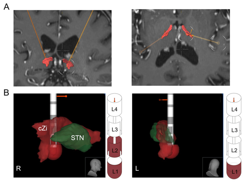 Effects of Low-Frequency Deep Brain Stimulation in Bilateral Zona Incerta for a Patient With Tremor and Cerebellar Ataxia.