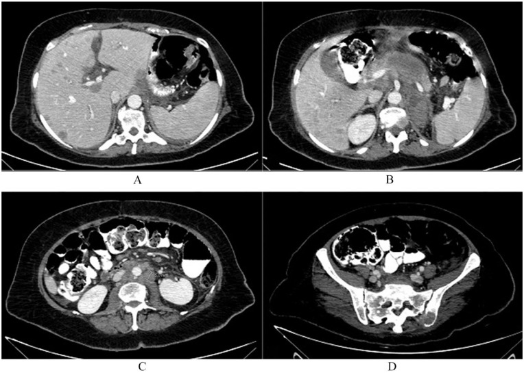 Microangiopathic Hemolytic Anemia as a Paraneoplastic Syndrome in a Patient with Metastatic Gastric Cancer.
