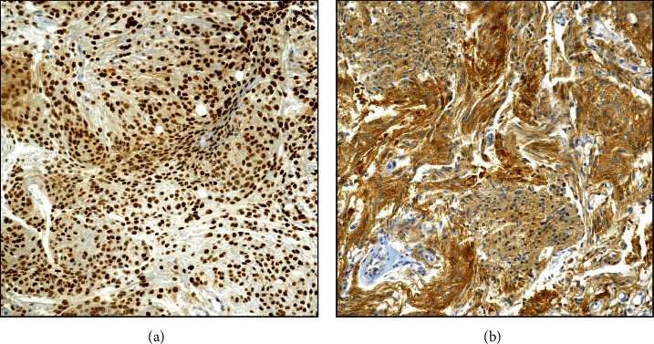 Immunohistochemical Profile of p62/SQSTM1/Sequestosome-1 in Human Low- and High-Grade Intracranial Meningiomas.