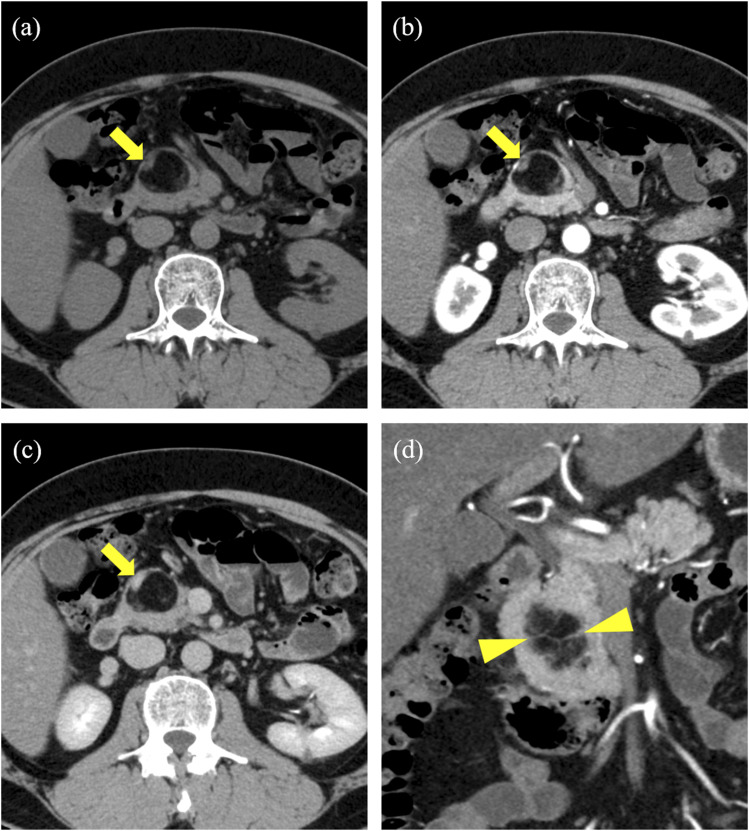 Lipomatous pseudohypertrophy of the pancreas mimicking liposarcoma: A case report.