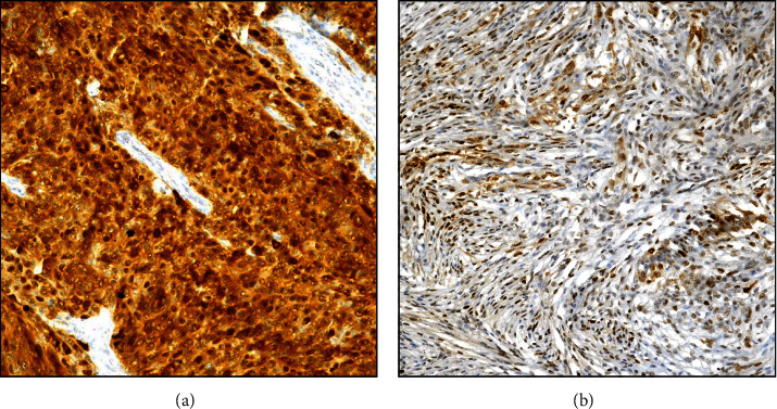 Immunohistochemical Profile of p62/SQSTM1/Sequestosome-1 in Human Low- and High-Grade Intracranial Meningiomas.