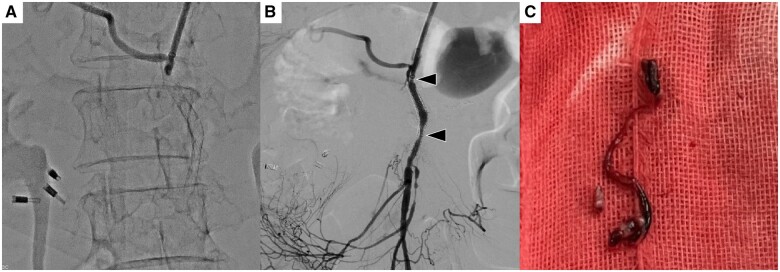 A case of superior mesenteric artery stenting for small intestinal ischaemia caused by superior mesenteric artery invasion of pancreatic cancer.