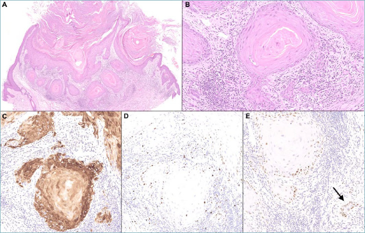 The 2023 WHO updates on skin tumors: advances since the 2018 edition.