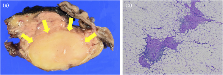 Lipomatous pseudohypertrophy of the pancreas mimicking liposarcoma: A case report.