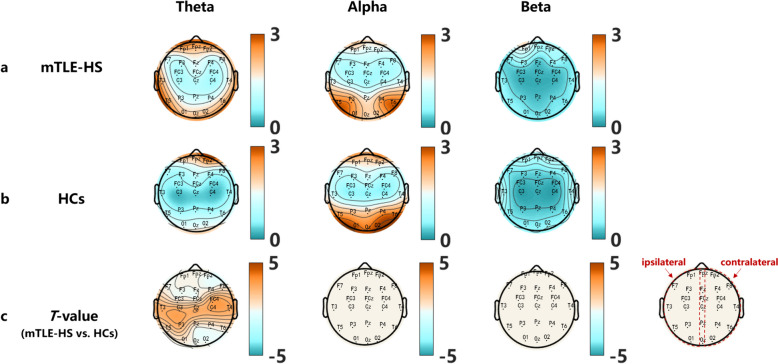 Differences and potential mechanisms of theta oscillation and temporoparietal and temporal-central networks in temporal lobe epilepsy patients with unilateral hippocampal sclerosis.