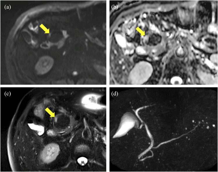 Lipomatous pseudohypertrophy of the pancreas mimicking liposarcoma: A case report.