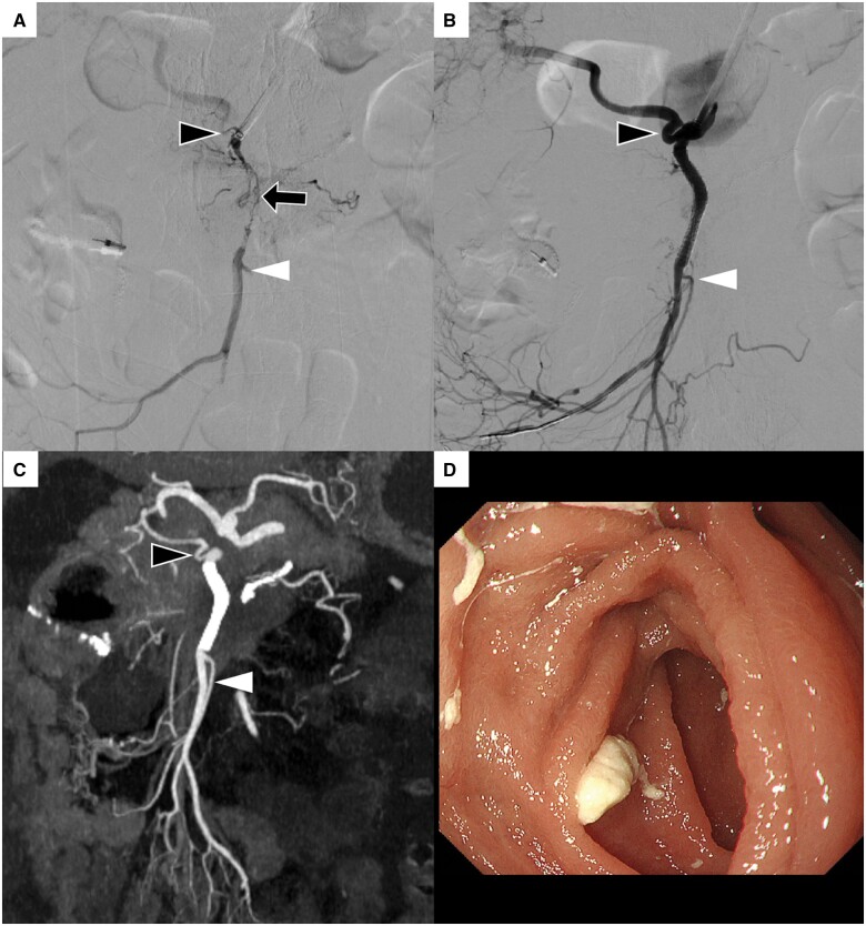 A case of superior mesenteric artery stenting for small intestinal ischaemia caused by superior mesenteric artery invasion of pancreatic cancer.