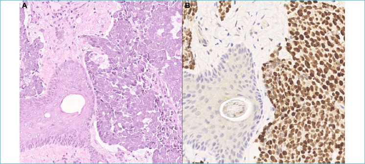 The 2023 WHO updates on skin tumors: advances since the 2018 edition.