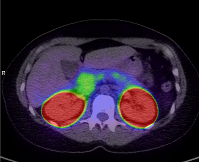 A tale of two sisters - delayed diagnosis of genetic hyperinsulinaemic hypoglycaemia.