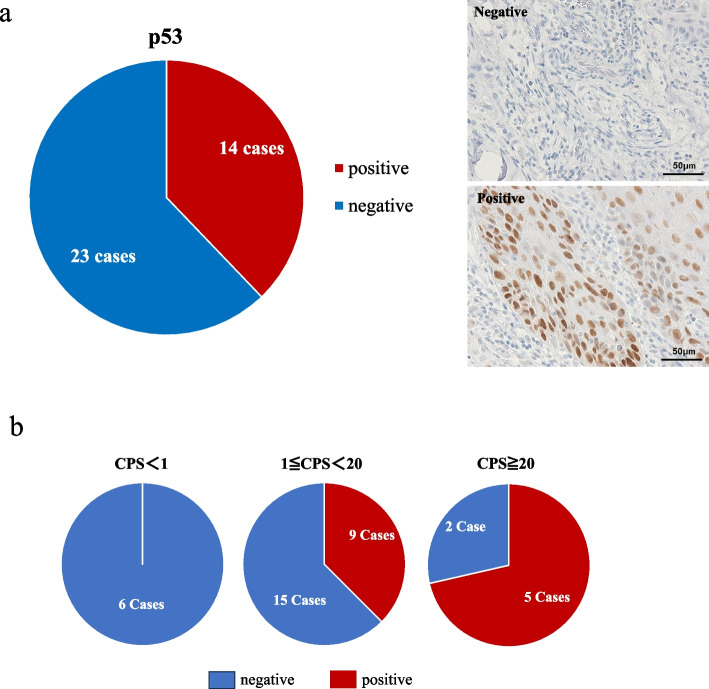 Pathological examination of factors involved in PD-L1 expression in patients with oral tongue squamous cell carcinoma.