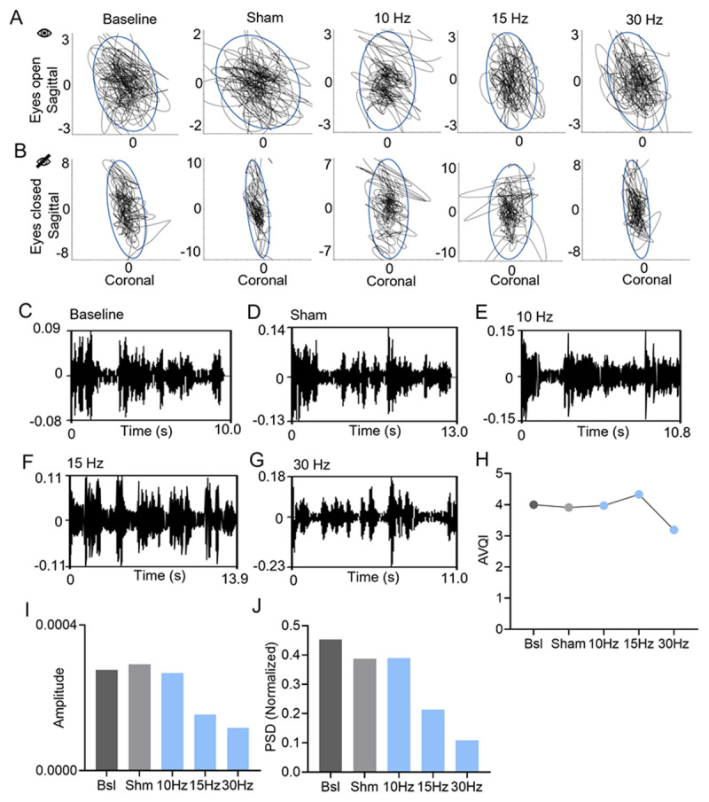 Effects of Low-Frequency Deep Brain Stimulation in Bilateral Zona Incerta for a Patient With Tremor and Cerebellar Ataxia.