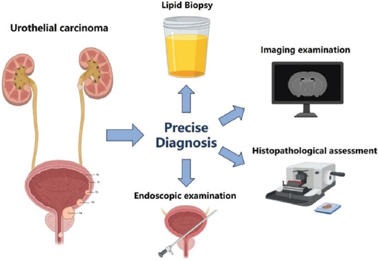 A narrative review of advances in the management of urothelial cancer: Diagnostics and treatments.