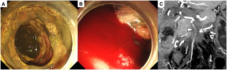 A case of superior mesenteric artery stenting for small intestinal ischaemia caused by superior mesenteric artery invasion of pancreatic cancer.