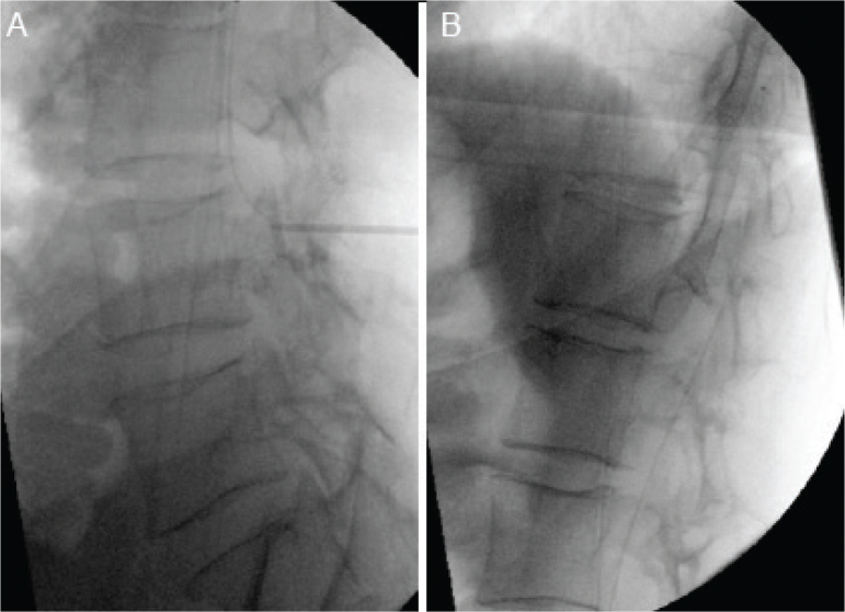 INTRATHECAL BACLOFEN FOR NEUROFIBROMATOSIS RELATED SPINAL CORD INJURY WITH SPASTICITY - A CASE REPORT.