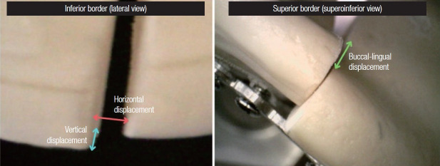 Usability testing of a novel interlocking three-dimensional miniplate for mandibular angle fractures.