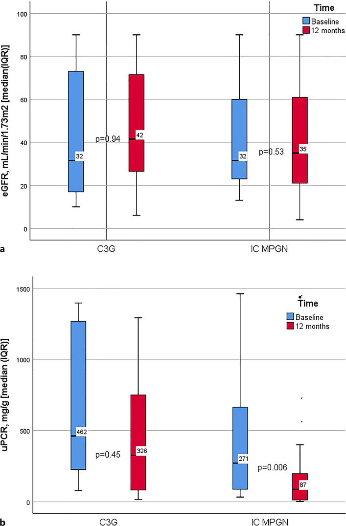Membranoproliferative Glomerulonephritis over 20 Years at a Tertiary Referral Center in the UK.