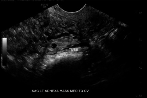 Successful Management of Spontaneous Unilateral Twin Ectopic Pregnancy With Two-Step Dose of Methotrexate.