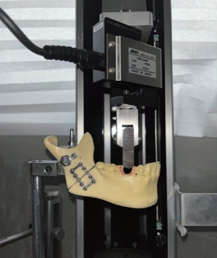 Usability testing of a novel interlocking three-dimensional miniplate for mandibular angle fractures.