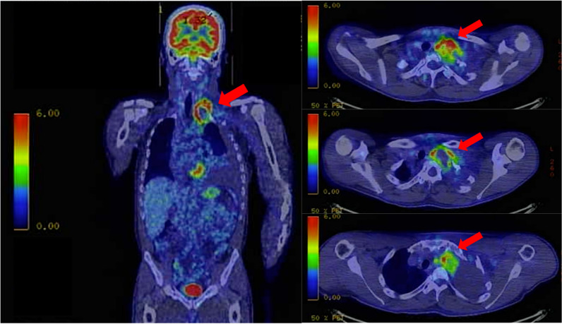 Endovascular treatment of contained ruptured internal thoracic artery aneurysm mimicking a tumor in a patient with neurofibromatosis type 1: a case report.
