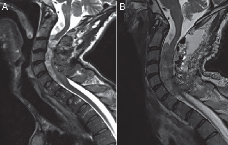 INTRATHECAL BACLOFEN FOR NEUROFIBROMATOSIS RELATED SPINAL CORD INJURY WITH SPASTICITY - A CASE REPORT.