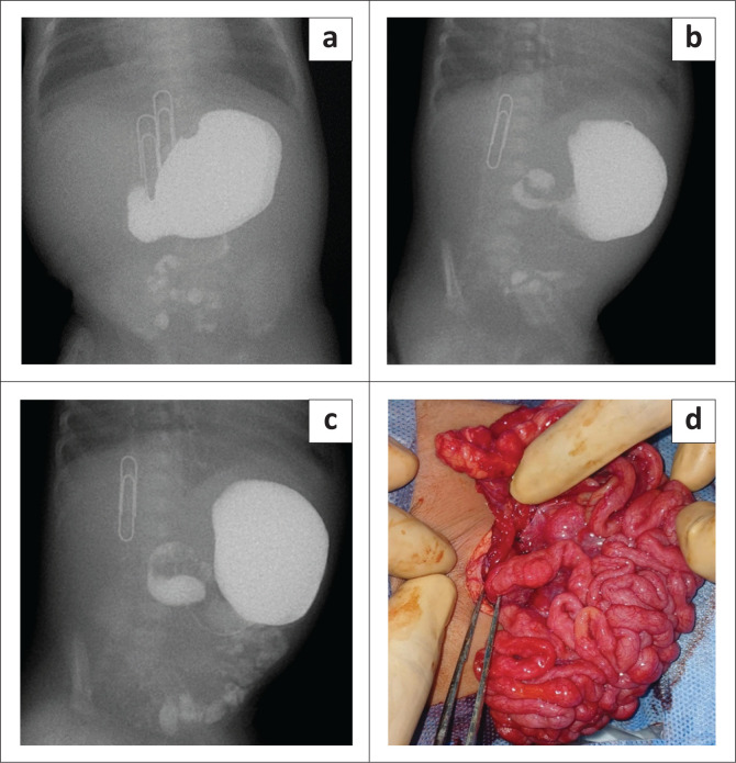 Malrotation with mid-gut volvulus and partial small bowel peritoneal membrane encapsulation.