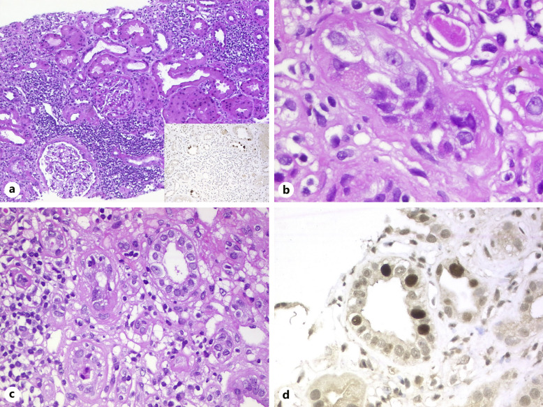 JC Polyomavirus Nephropathy: A Rare Complication Late after Kidney Transplantation.