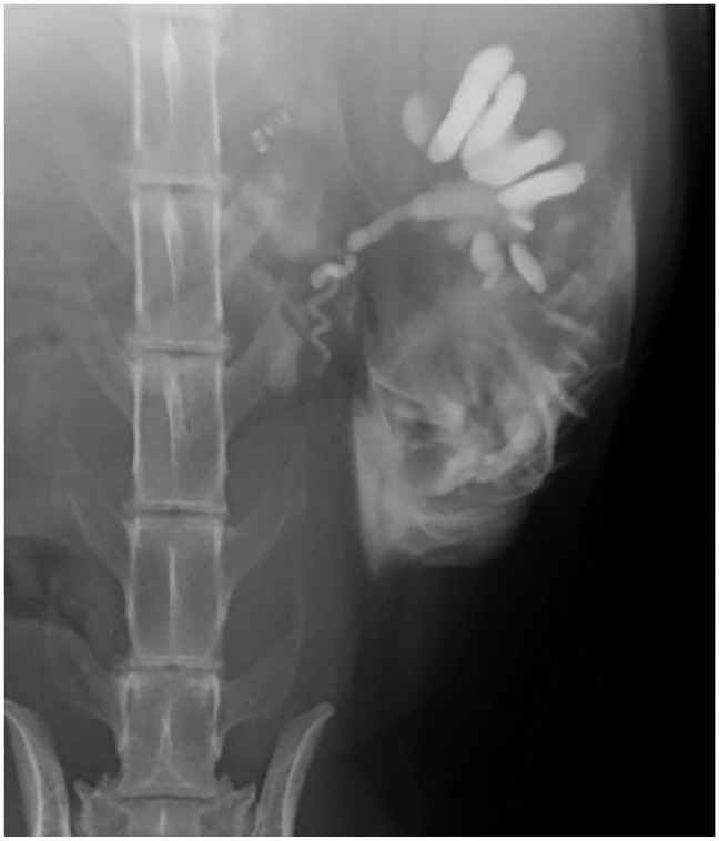 Subcutaneous ureteral bypass for treatment of proximal ureteral obstruction secondary to retroperitoneal fibrosis after renal transplantation in a cat.