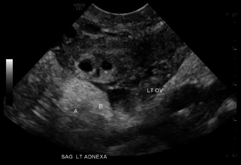 Successful Management of Spontaneous Unilateral Twin Ectopic Pregnancy With Two-Step Dose of Methotrexate.