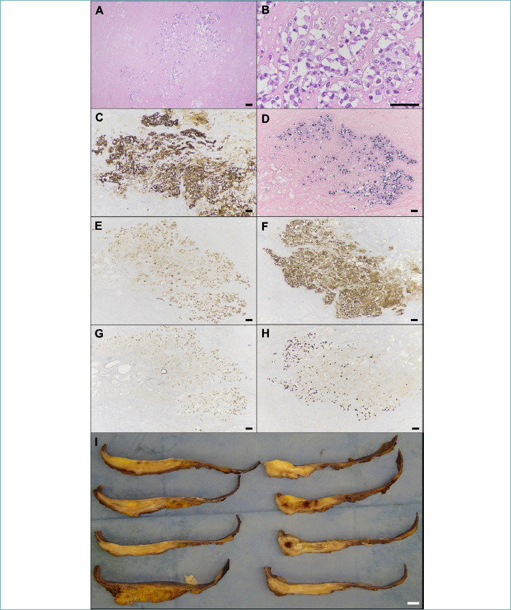 Fibrin associated large B-cell lymphoma accidentally identified in a breast implant capsule: a molecular report of a rare entity.