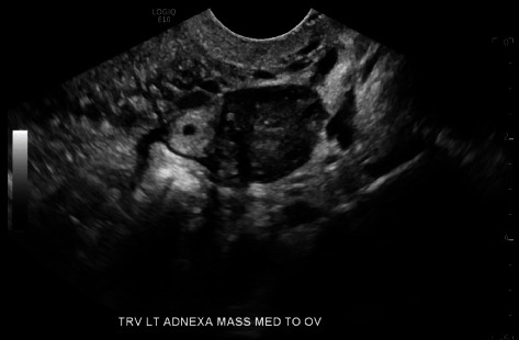 Successful Management of Spontaneous Unilateral Twin Ectopic Pregnancy With Two-Step Dose of Methotrexate.