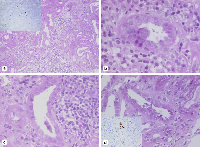JC Polyomavirus Nephropathy: A Rare Complication Late after Kidney Transplantation.