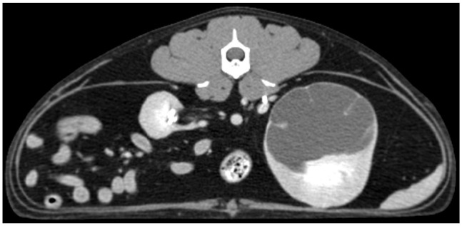 Subcutaneous ureteral bypass for treatment of proximal ureteral obstruction secondary to retroperitoneal fibrosis after renal transplantation in a cat.