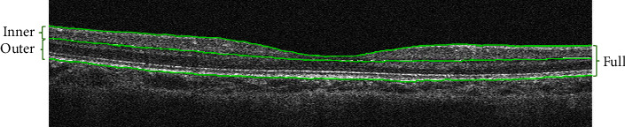 The Association of Myopia Progression with Changes in Retinal Thickness among Primary School Students with Myopia.