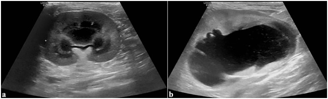 Subcutaneous ureteral bypass for treatment of proximal ureteral obstruction secondary to retroperitoneal fibrosis after renal transplantation in a cat.
