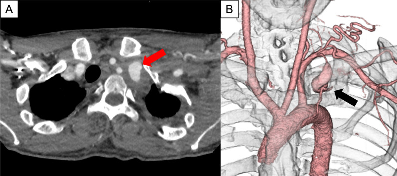 Endovascular treatment of contained ruptured internal thoracic artery aneurysm mimicking a tumor in a patient with neurofibromatosis type 1: a case report.