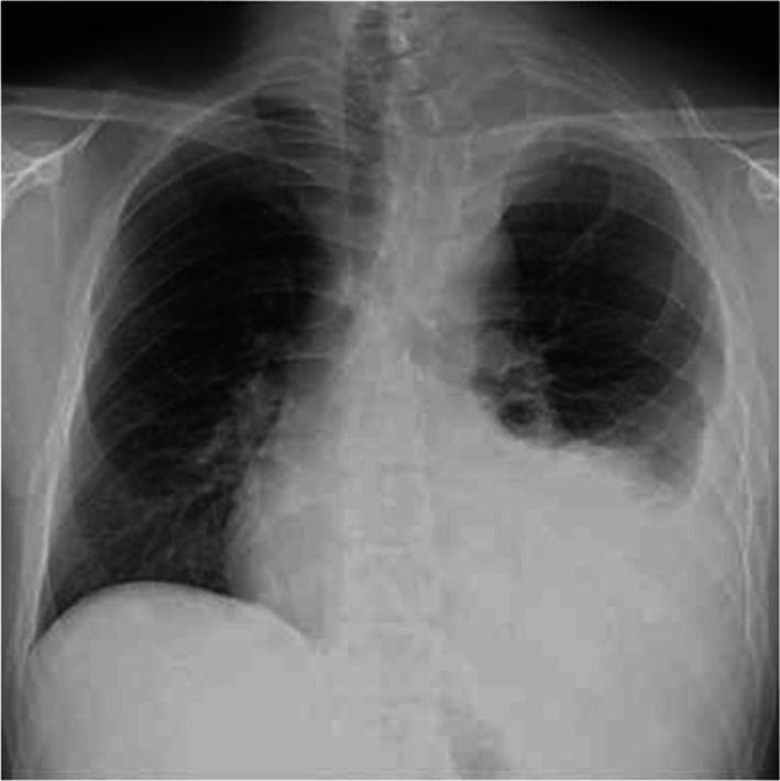 Endovascular treatment of contained ruptured internal thoracic artery aneurysm mimicking a tumor in a patient with neurofibromatosis type 1: a case report.