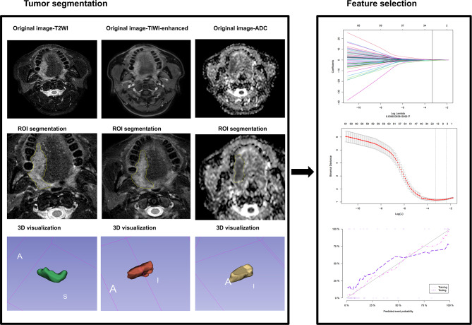 A novel nomogram for predicting overall survival in patients with tongue squamous cell carcinoma using clinical features and MRI radiomics data: a pilot study.