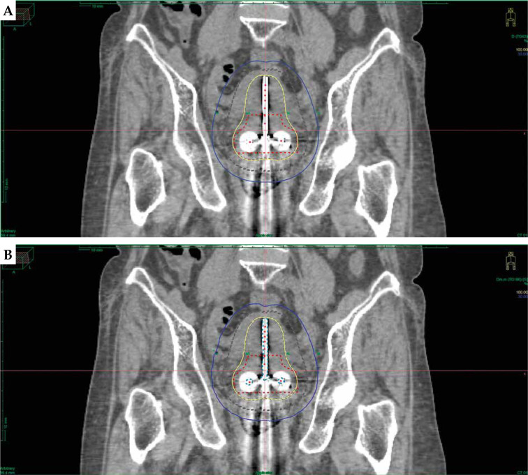 A comparison of TG-43 and TG-186 dose calculation algorithms for treatment planning of intra-cavitary brachytherapy using tandem and ovoid applicator.