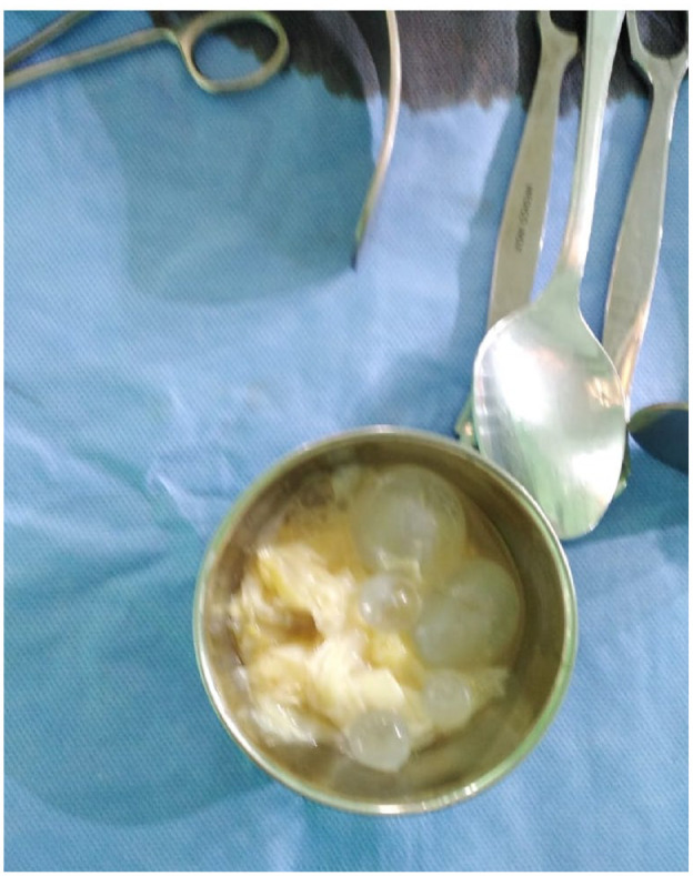 Peritonitis Secondary to Ruptured Hydatid Liver Cyst in a Young Postpartum Woman: A Rare Case Report.