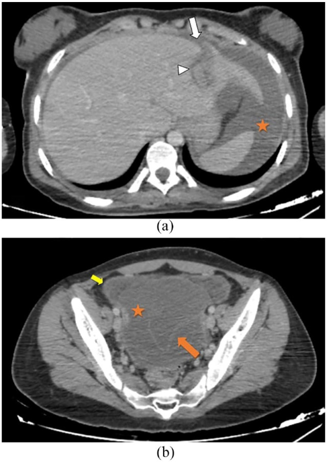 Peritonitis Secondary to Ruptured Hydatid Liver Cyst in a Young Postpartum Woman: A Rare Case Report.