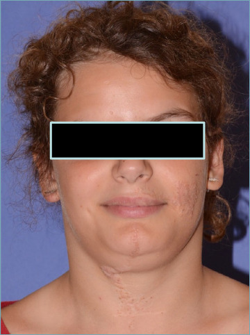 Oral sialadenoma papilliferum with kras mutation in a patient with linear nevus sebaceous syndrome.