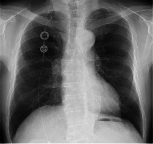 Delayed recovery of consciousness from anesthesia due to exacerbation of hydrocephalus caused by a ventriculoperitoneal shunt malfunction during general anesthesia in the prone position: a case report.