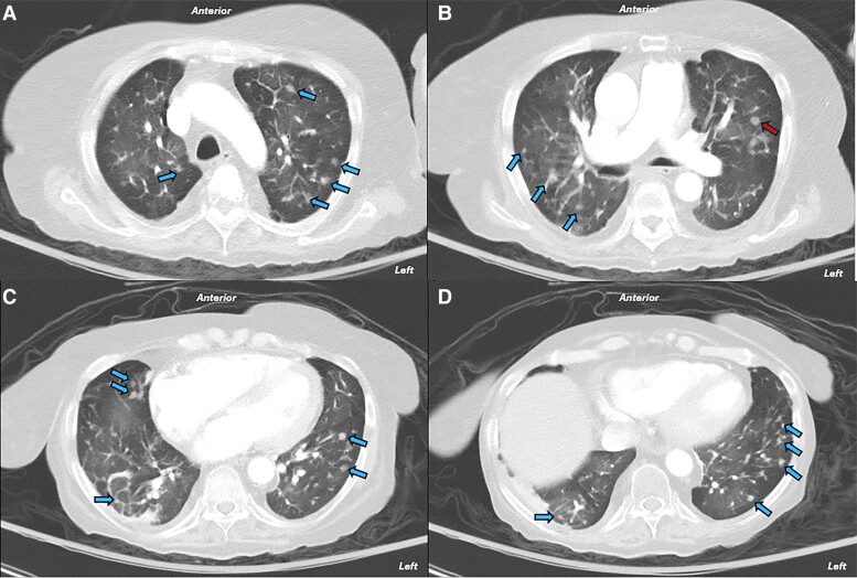 Ectopic Cushing Syndrome Secondary to Diffuse Idiopathic Neuroendocrine Cell Hyperplasia-A Report of 2 Cases.