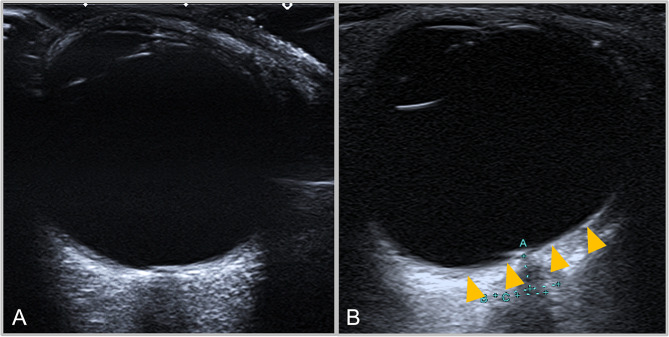 Transorbital B-mode ultrasound for the assessment of posterior globe flattening in idiopathic intracranial hypertension: a pilot study.