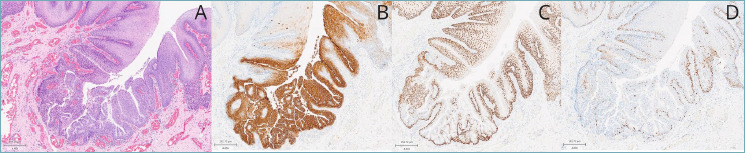 Oral sialadenoma papilliferum with kras mutation in a patient with linear nevus sebaceous syndrome.